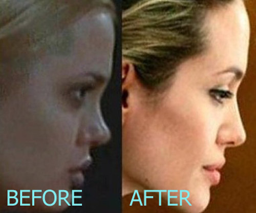Angelina Jolie Plastic Surgery Before and After
