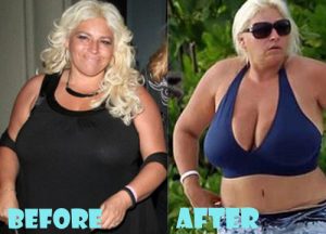 Beth Chapman Plastic Surgery