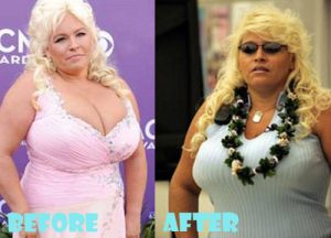 Beth Chapman Plastic Surgery Tummy Tuck
