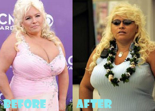 Beth Chapman Plastic Surgery Tummy Tuck - Lovely Surgery ...