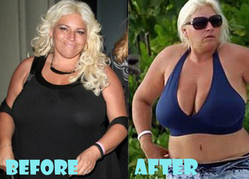 Beth Chapman Plastic Surgery