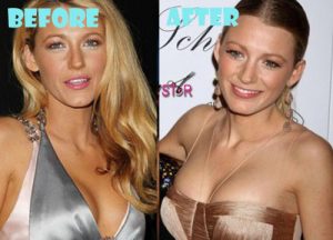 Blake Lively Plastic Surgery Breast Implant