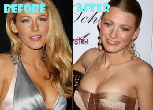 Blake Lively Plastic Surgery Breast Implant Before and After.