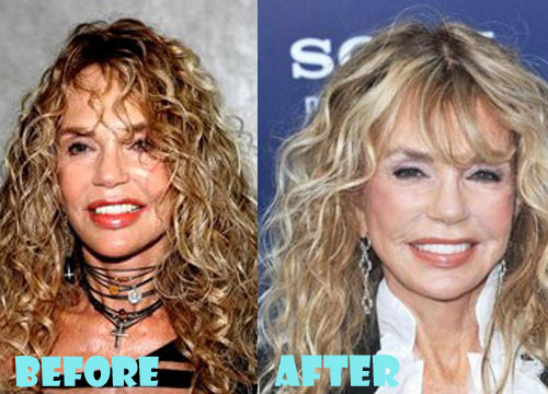 Dyan Cannon Plastic Surgery Before and After Pictures