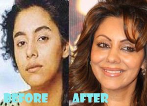 Gauri Khan Plastic Surgery