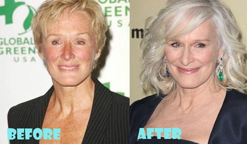 Glenn Close Plastic Surgery Before and After