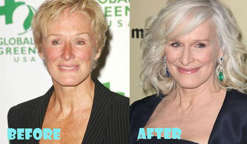 Glenn Close Plastic Surgery