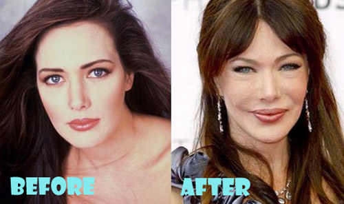 Hunter Tylo Plastic Surgery Before And After
