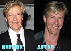 Jack Wagner Plastic Surgery