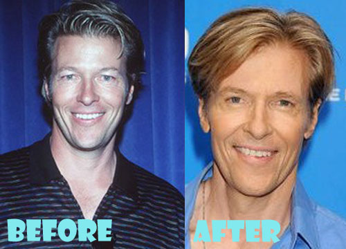 Jack Wagner Plastic Surgery Before and After Photos