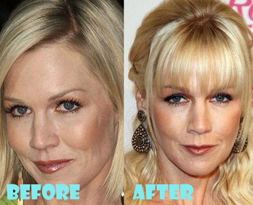 Jennie Garth Plastic Surgery Before and After