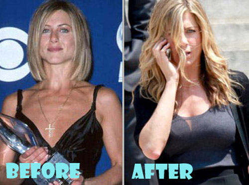 Jennifer Aniston Plastic Surgery Before And After
