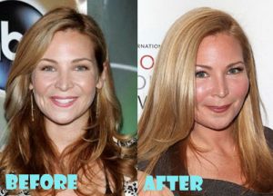 Jennifer Westfeldt Plastic Surgery
