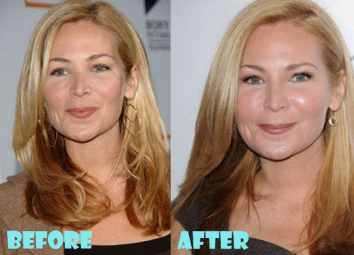 Jennifer Westfeldt Plastic Surgery Botox, Cheek Augmentation, Facelift