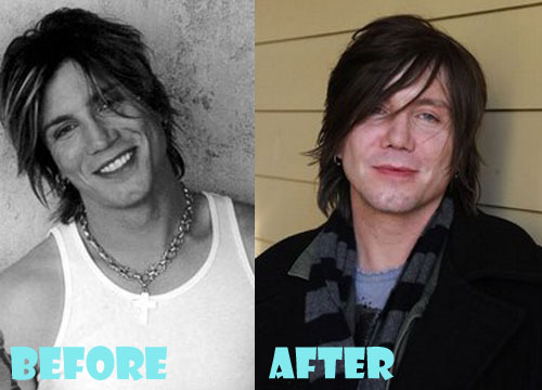 John Rzeznik Plastic Surgery Before and After Picture