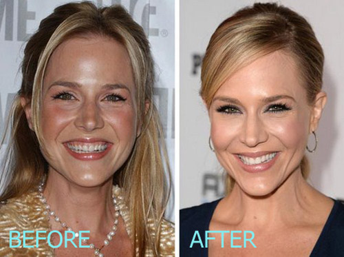 Julie Benz Plastic Surgery Before and After