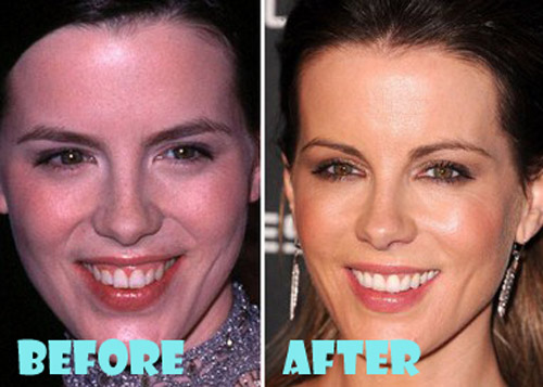 Kate Beckinsale Plastic Surgery Before and After