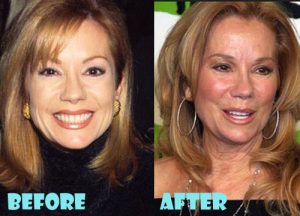 Kathie Lee Gifford Plastic Surgery Facelift, Facial Filler