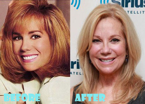Kathie Lee Gifford Plastic Surgery Before and After
