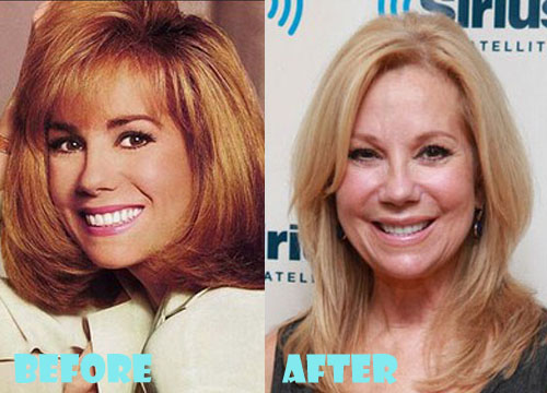 Kathie Lee Gifford Plastic Surgery