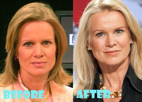 Katty Kay Plastic Surgery Before and After Picture