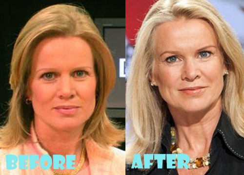 Katty Kay Plastic Surgery