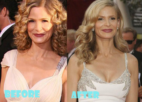 Kyra Sedgwick Plastic Surgery Before and After