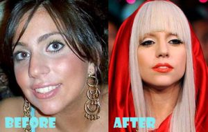 Lady Gaga Plastic Surgery Nose Job