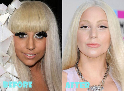 Lady Gaga Plastic Surgery Before and After Nose Job