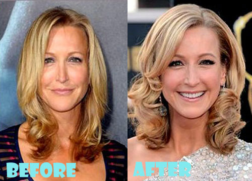 Lara Spencer Plastic Surgery Before and After