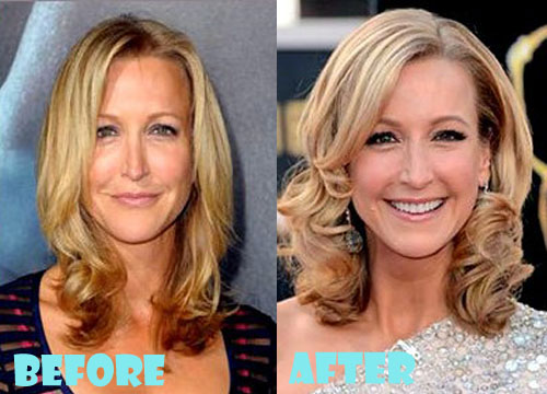 Lara Spencer Plastic Surgery Botox, Tummy Tuck