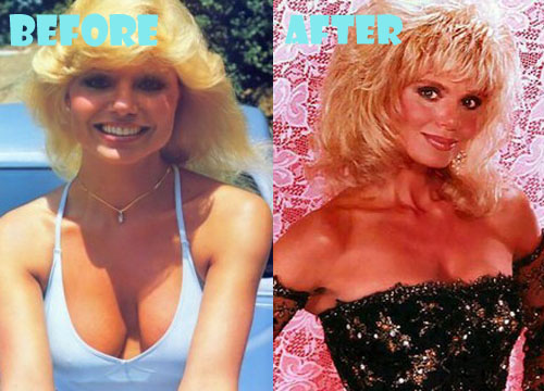 Loni Anderson Plastic Surgery Boob Job