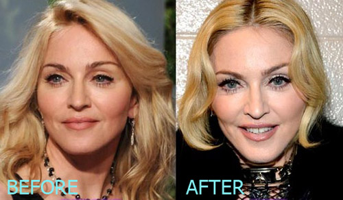 Madonna Plastic Surgery Before and After