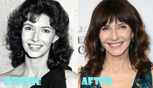 Mary Steenburgen Plastic Surgery Before and After