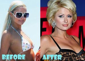 Paris Hilton Plastic Surgery
