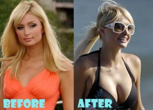 Paris Hilton Plastic Surgery Breast Implant
