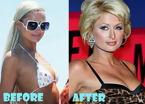 Paris Hilton Plastic Surgery Before and After Breast Implant