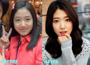 Park Shin Hye Plastic Surgery