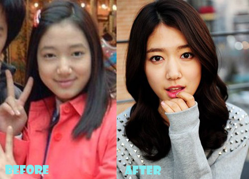 Park Shin Hye Plastic Surgery Before and After