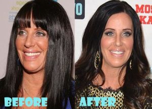 Patti Stanger Plastic Surgery