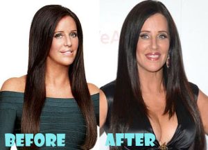 Patti Stanger Plastic Surgery Breast Reduction
