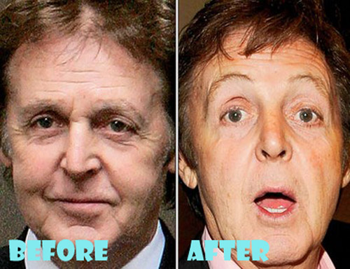 Paul McCartney Plastic Surgery Before and After