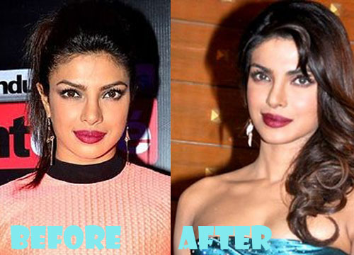 Priyanka Chopra Plastic Surgery Before and After Pictures - Lovely Surgery