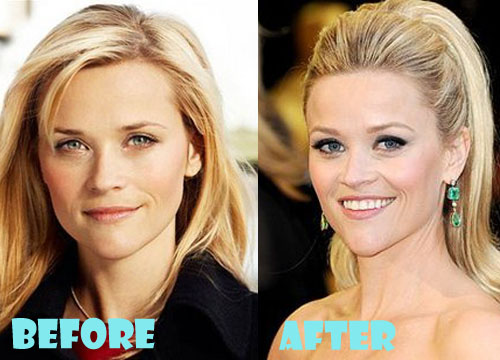 Reese Witherspoon Plastic Surgery Before and After