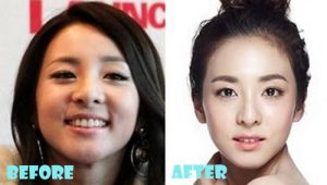 Sandara Park Plastic Surgery Nose Job