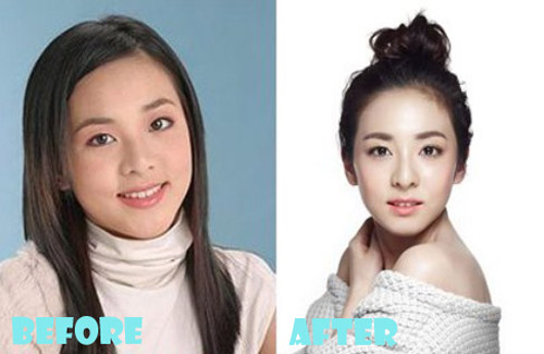 Sandara Park Plastic Surgery Before and After
