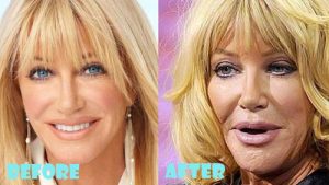 Suzanne Somers Plastic Surgery Lip Implant