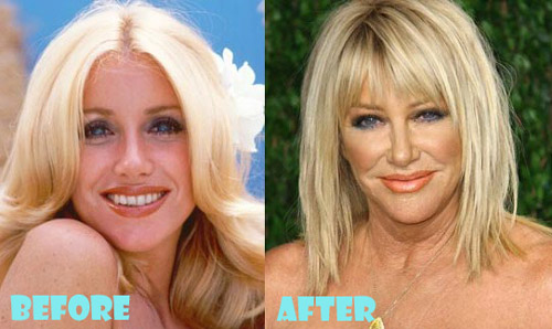 Suzanne Somers Plastic Surgery Before and After
