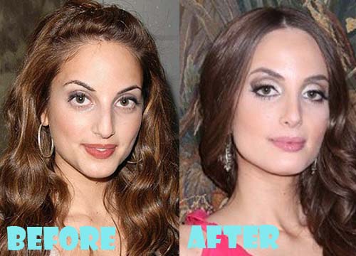 Alexa Ray Joel Plastic Surgery Before and After Nose Job