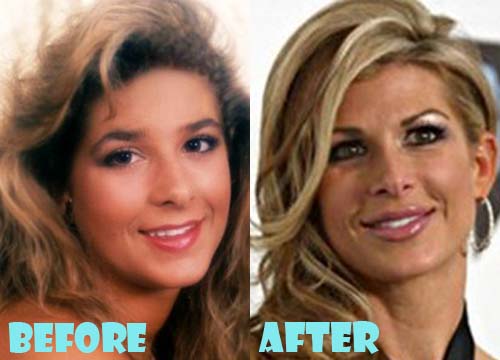 Alexis Bellino Plastic Surgery Nose Job